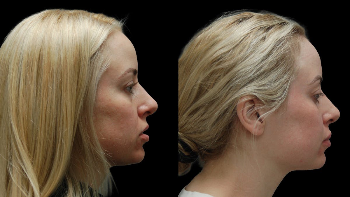 Lower Eyelid Surgery Before & After Gallery - Patient 367254 - Image 10