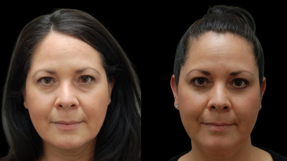 Lower Eyelid Surgery Before & After Gallery - Patient 142688 - Image 2