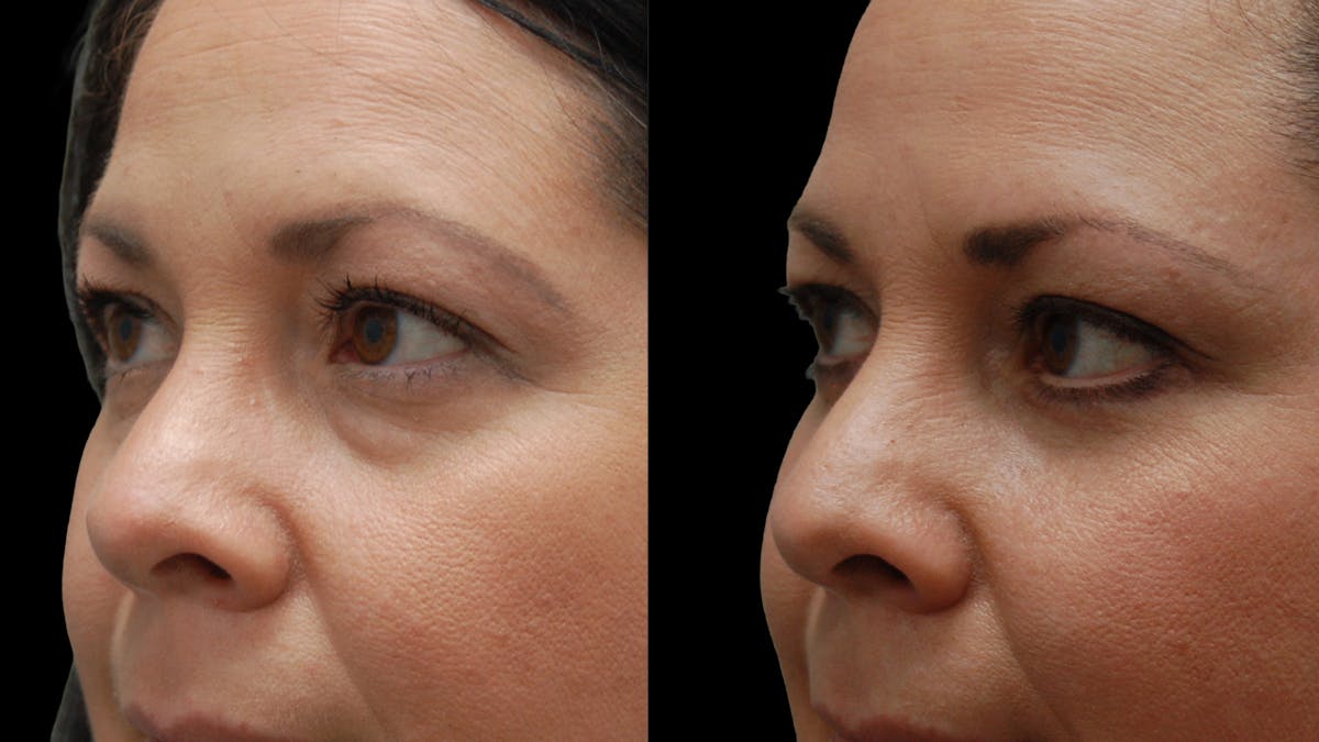 Lower Eyelid Surgery Before & After Gallery - Patient 142688 - Image 6