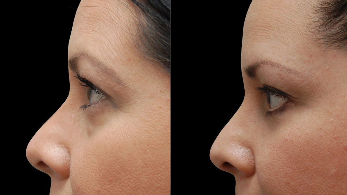 Lower Eyelid Surgery Before & After Gallery - Patient 142688 - Image 7