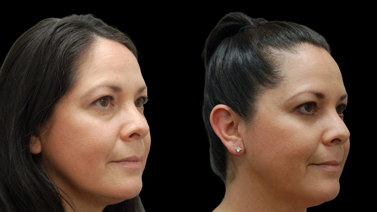 Lower Eyelid Surgery Before & After Gallery - Patient 142688 - Image 3