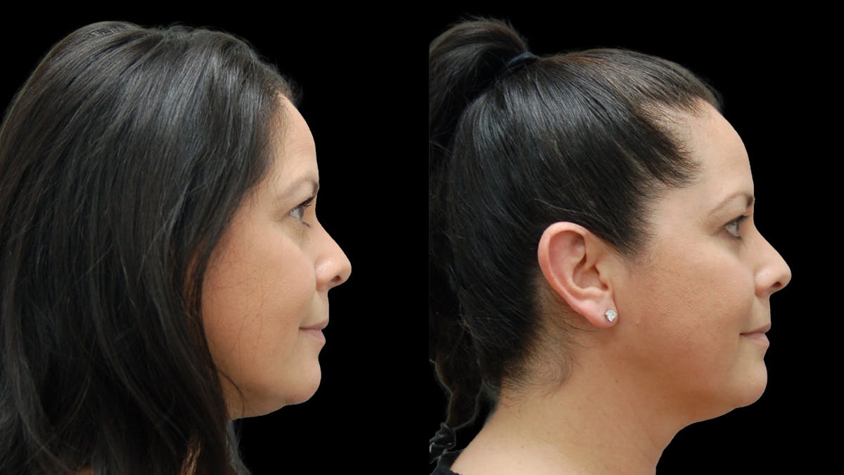 Lower Eyelid Surgery Before & After Gallery - Patient 142688 - Image 4