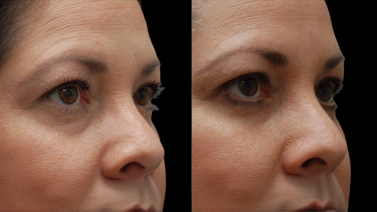 Lower Eyelid Surgery Before & After Gallery - Patient 142688 - Image 8