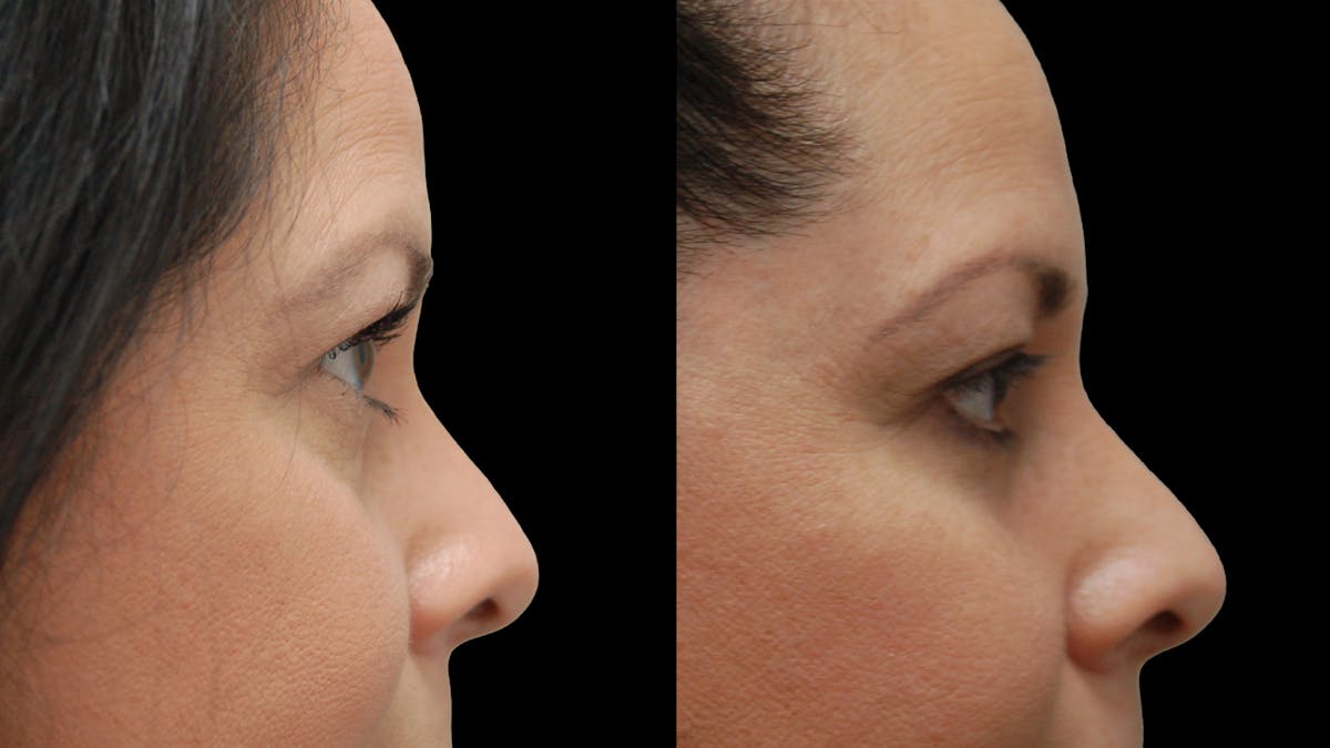 Lower Eyelid Surgery Before & After Gallery - Patient 142688 - Image 9