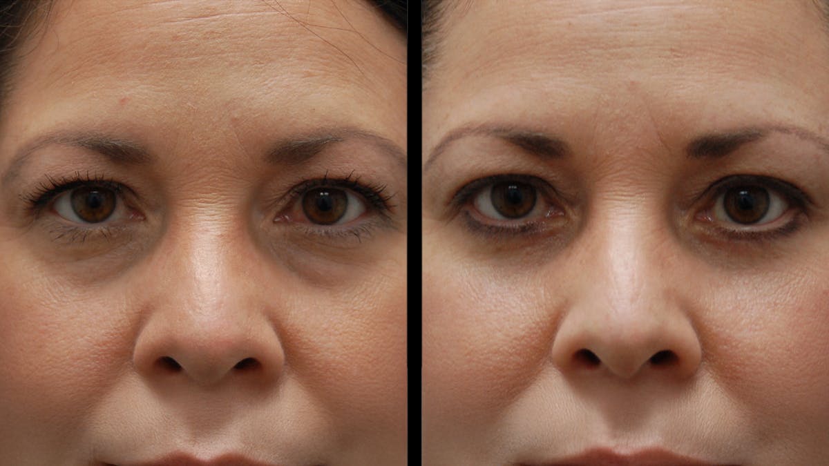 Lower Eyelid Surgery Before & After Gallery - Patient 142688 - Image 10