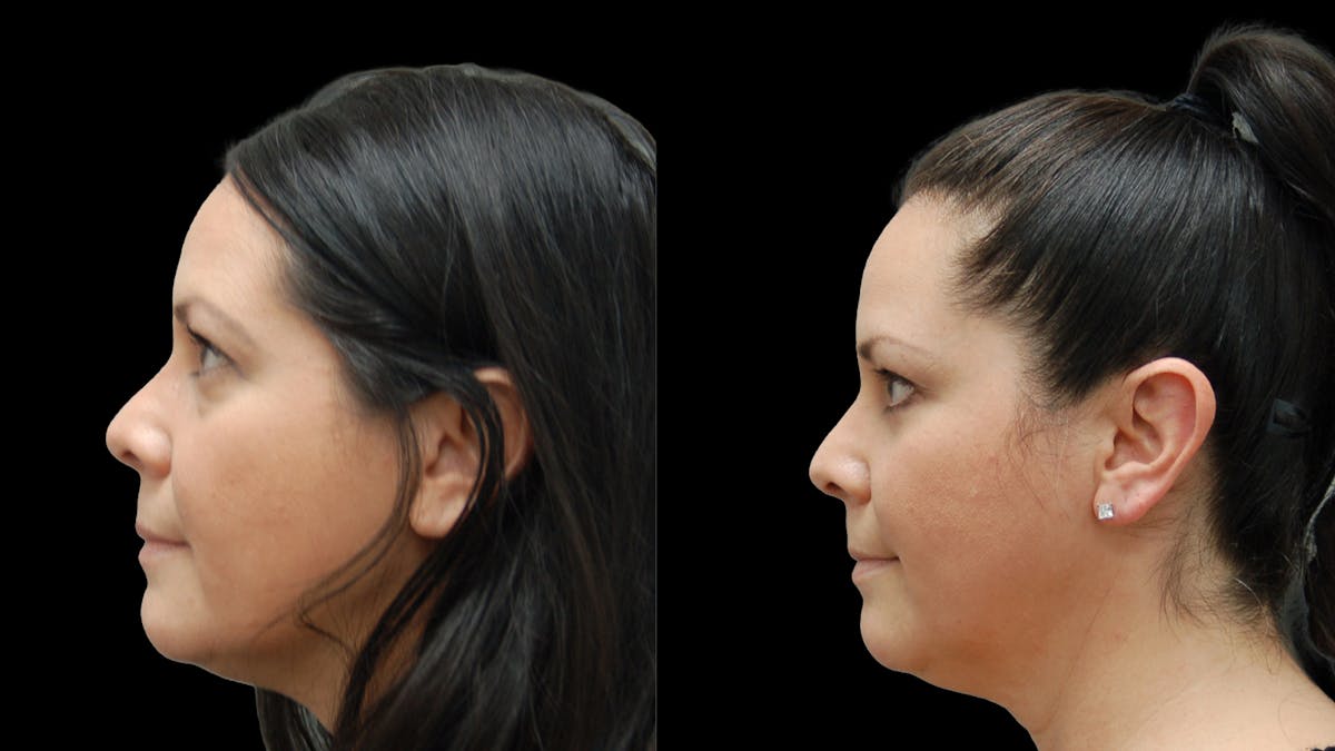 Lower Eyelid Surgery Before & After Gallery - Patient 142688 - Image 5