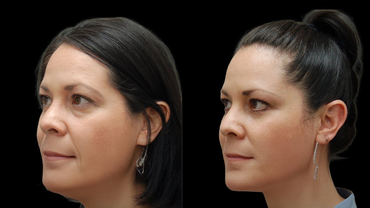 Lower Eyelid Surgery Before & After Gallery - Patient 142688 - Image 1