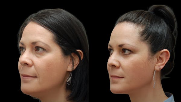 Lower Eyelid Surgery Before & After Gallery - Patient 142688 - Image 1