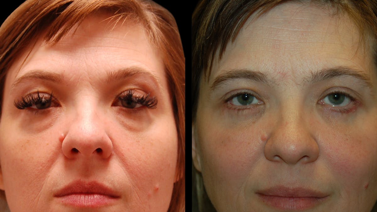 Lower Eyelid Surgery Before & After Gallery - Patient 393726 - Image 6