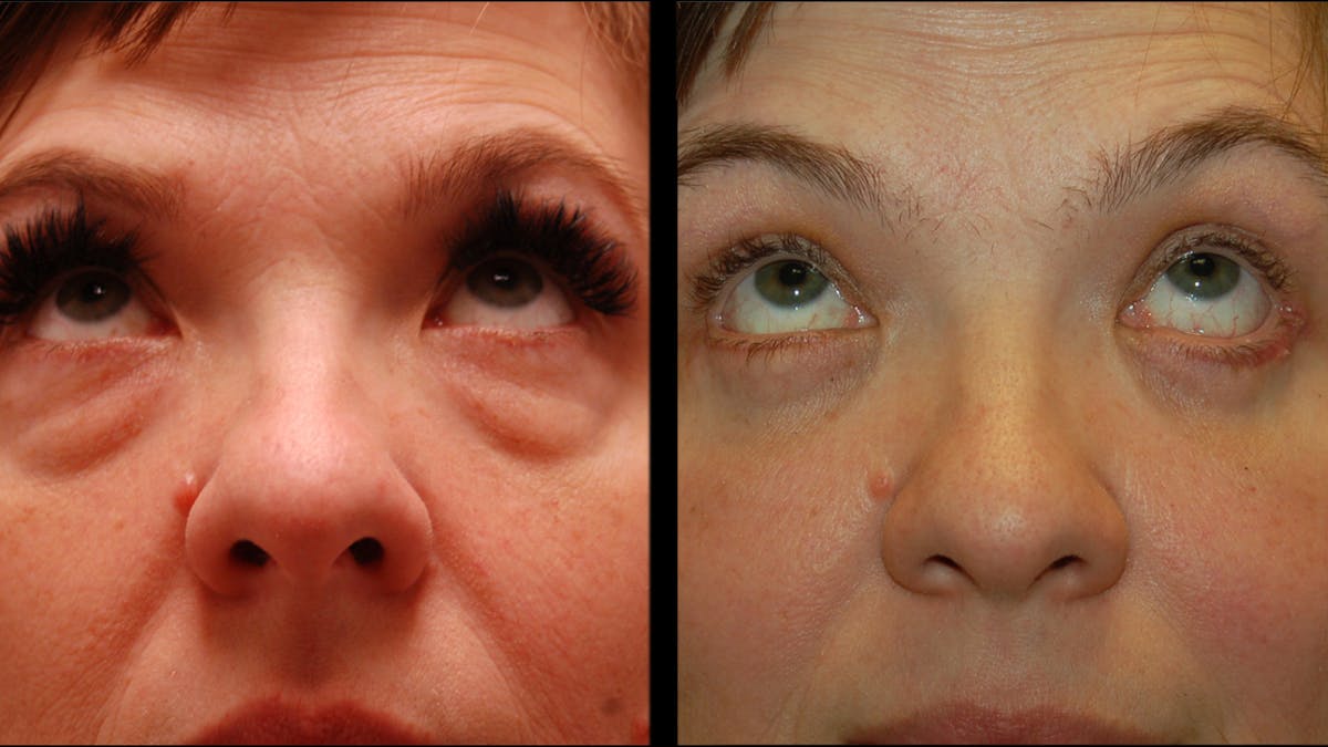 Lower Eyelid Surgery Before & After Gallery - Patient 393726 - Image 7