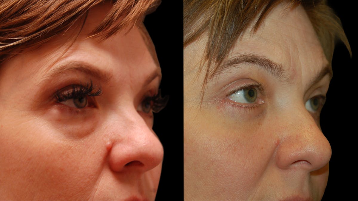 Lower Eyelid Surgery Before & After Gallery - Patient 393726 - Image 8