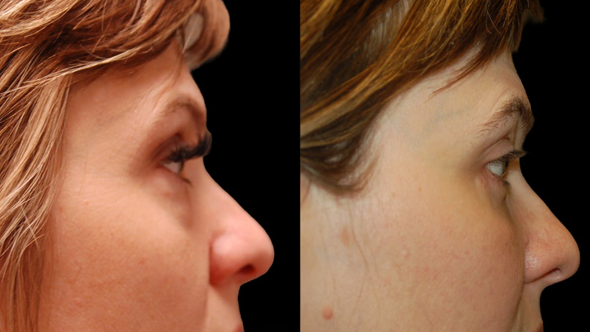 Lower Eyelid Surgery Before & After Gallery - Patient 393726 - Image 9