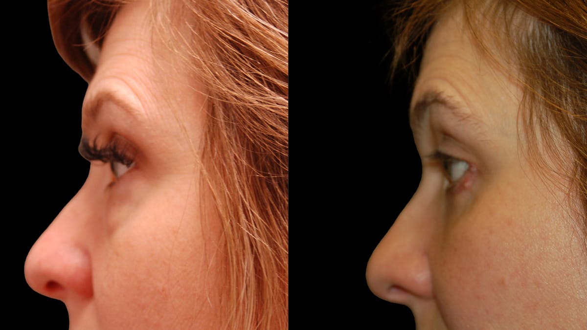 Lower Eyelid Surgery Before & After Gallery - Patient 393726 - Image 10