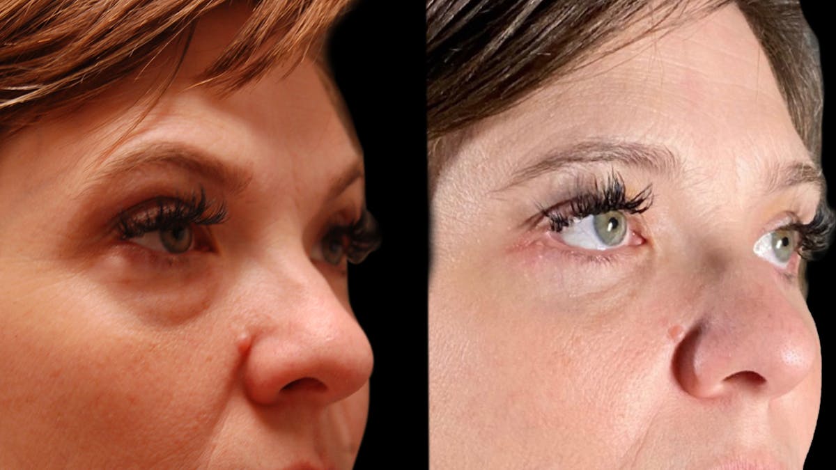 Lower Eyelid Surgery Before & After Gallery - Patient 393726 - Image 11
