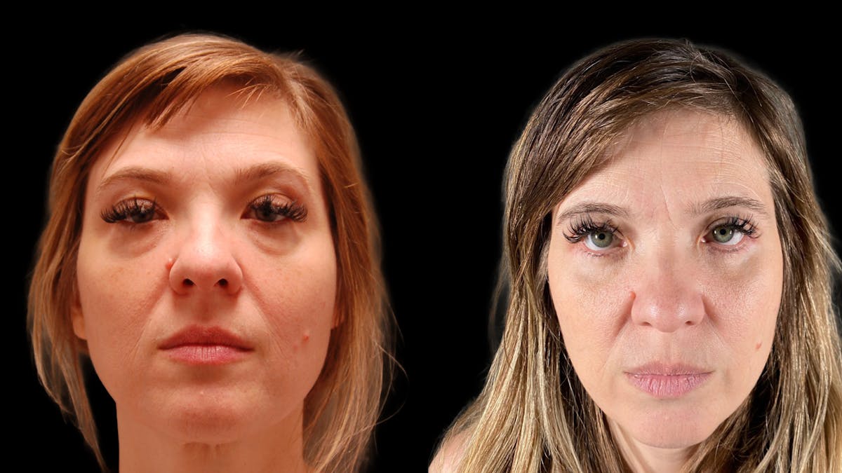 Lower Eyelid Surgery Before & After Gallery - Patient 393726 - Image 2