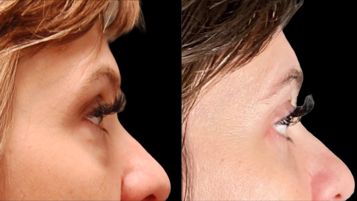 Lower Eyelid Surgery Before & After Gallery - Patient 393726 - Image 12