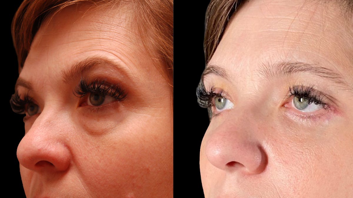 Lower Eyelid Surgery Before & After Gallery - Patient 393726 - Image 13