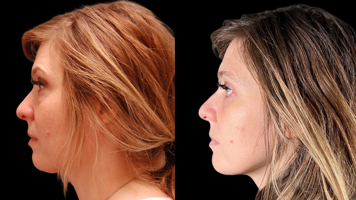 Lower Eyelid Surgery Before & After Gallery - Patient 393726 - Image 3