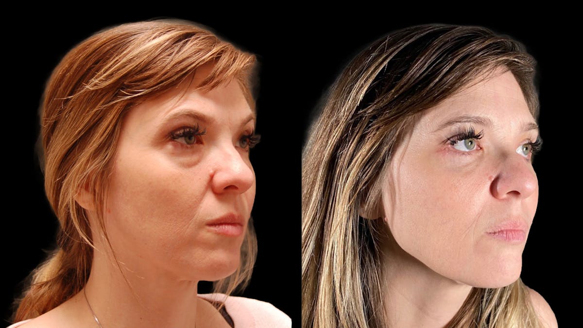 Lower Eyelid Surgery Before & After Gallery - Patient 393726 - Image 4