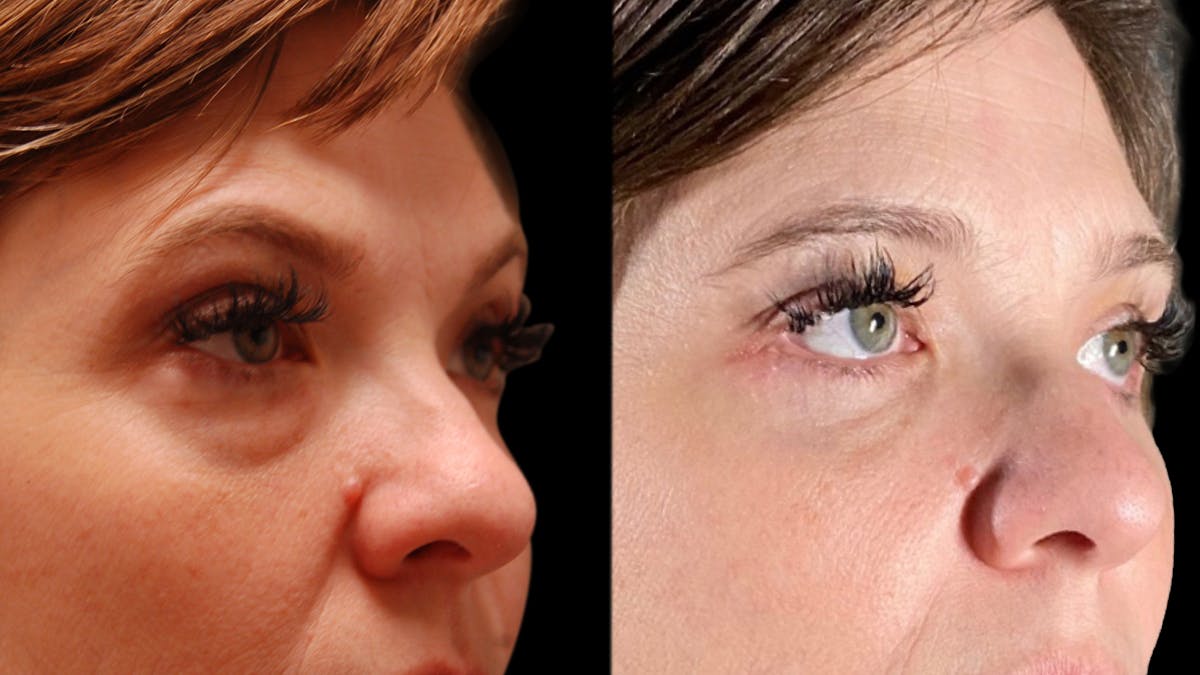 Lower Eyelid Surgery Before & After Gallery - Patient 393726 - Image 14