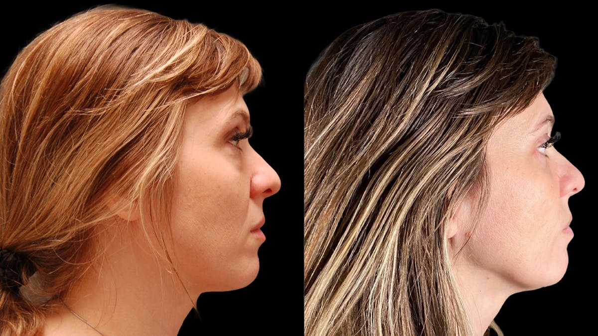 Lower Eyelid Surgery Before & After Gallery - Patient 393726 - Image 5