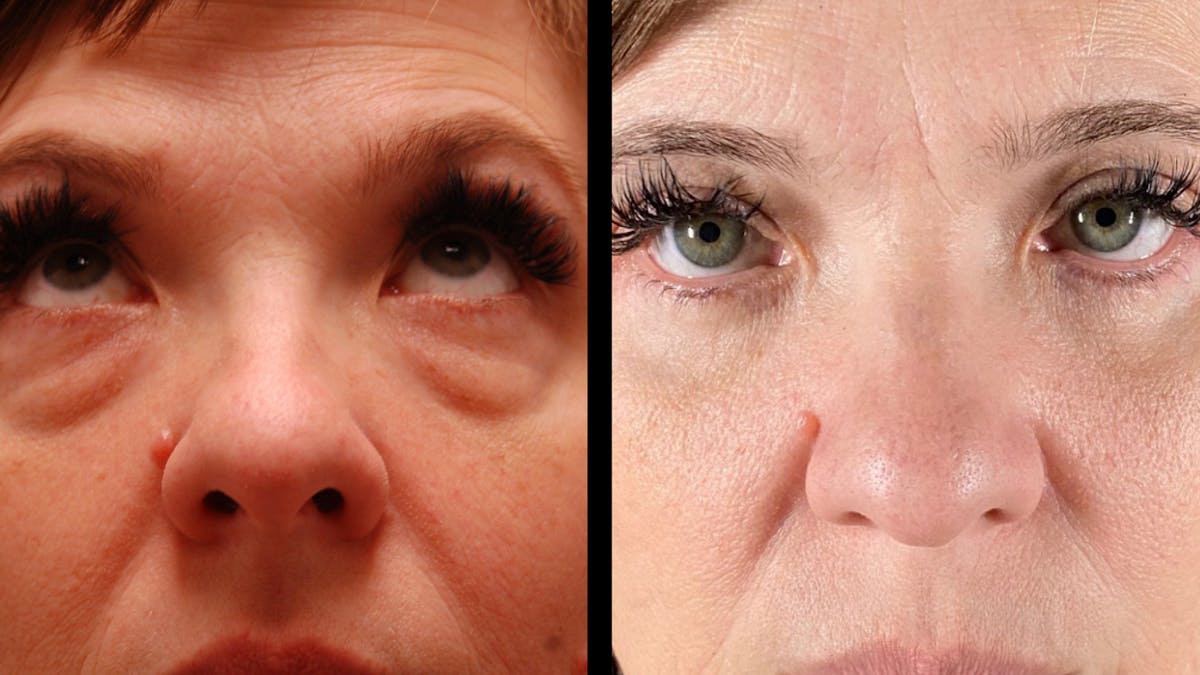 Lower Eyelid Surgery Before & After Gallery - Patient 393726 - Image 16
