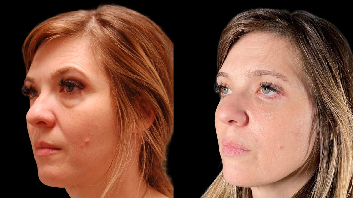 Lower Eyelid Surgery Before & After Gallery - Patient 393726 - Image 1