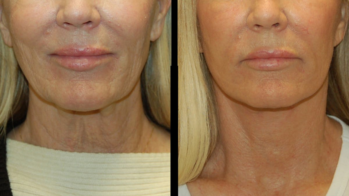 Lower Eyelid Surgery Before & After Gallery - Patient 132070 - Image 7