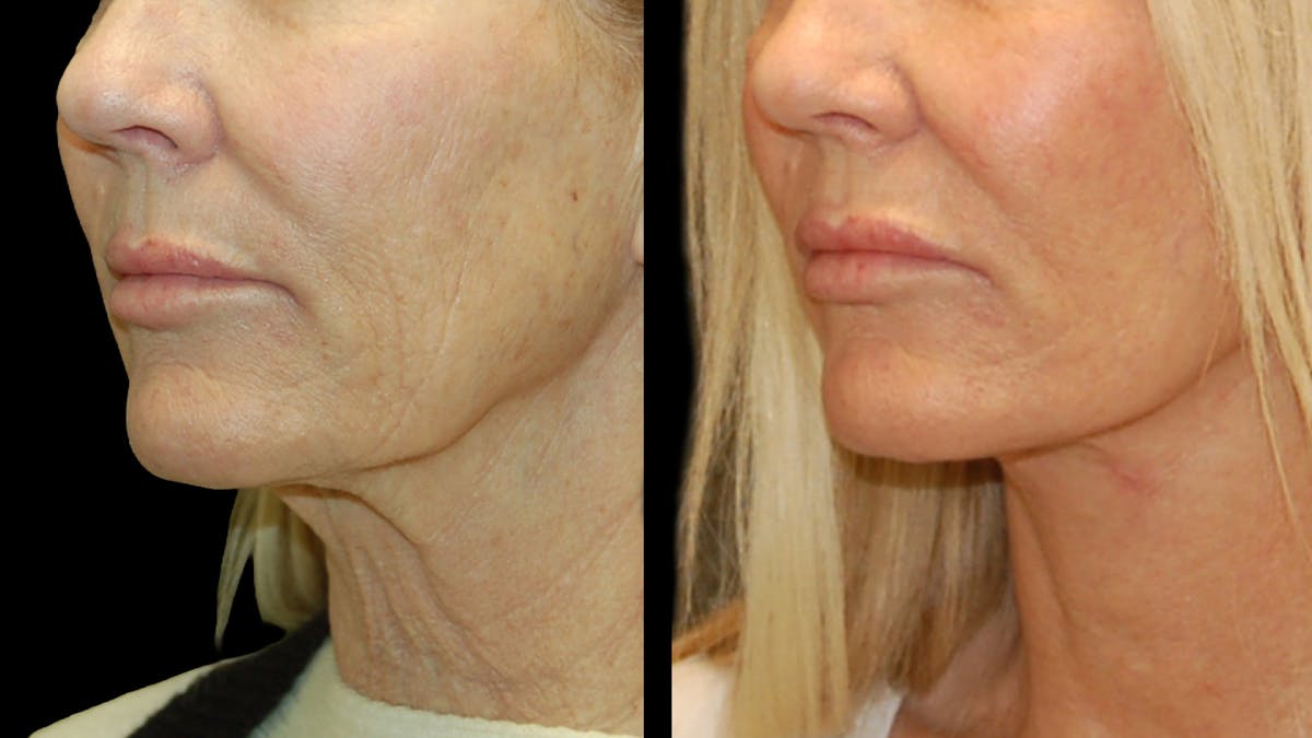 Lower Eyelid Surgery Before & After Gallery - Patient 132070 - Image 8