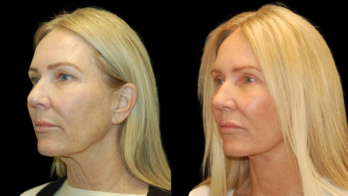 Lower Eyelid Surgery Before & After Gallery - Patient 132070 - Image 1