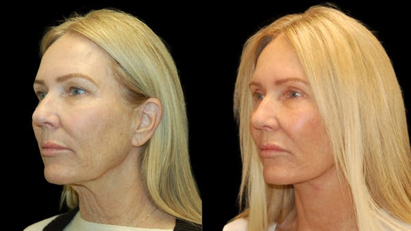 Lower Eyelid Surgery Before & After Gallery - Patient 132070 - Image 1