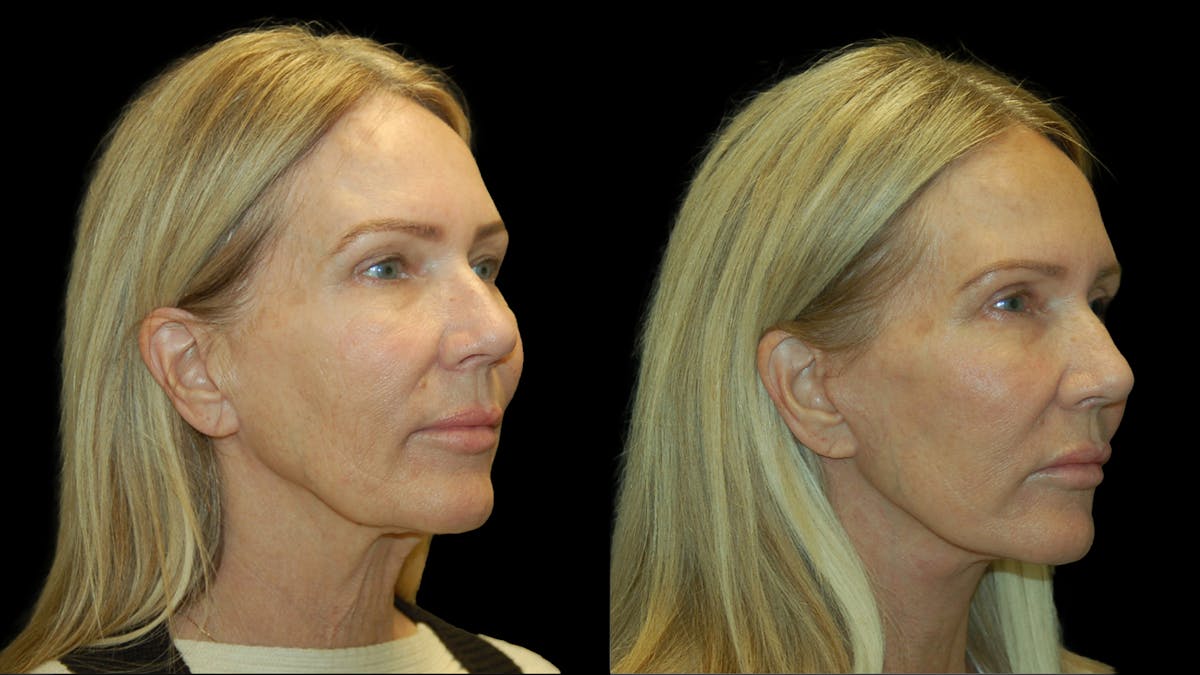 Lower Eyelid Surgery Before & After Gallery - Patient 132070 - Image 3