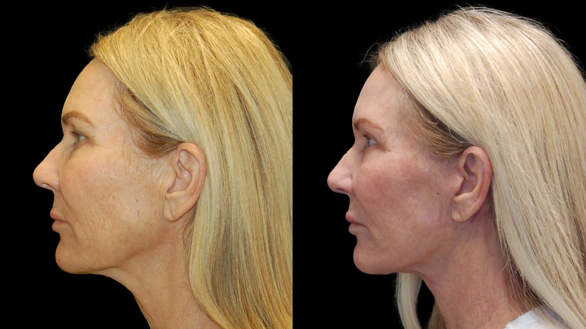 Lower Eyelid Surgery Before & After Gallery - Patient 132070 - Image 5