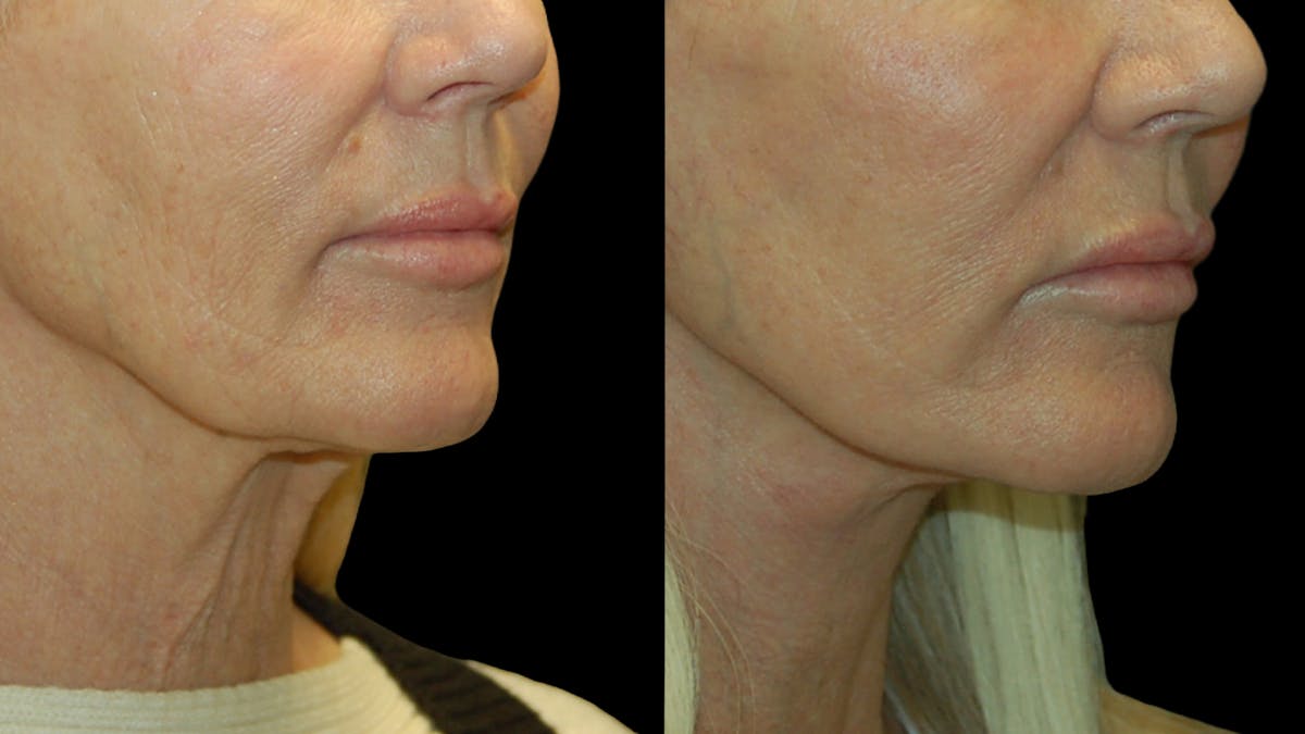 Lower Eyelid Surgery Before & After Gallery - Patient 132070 - Image 9