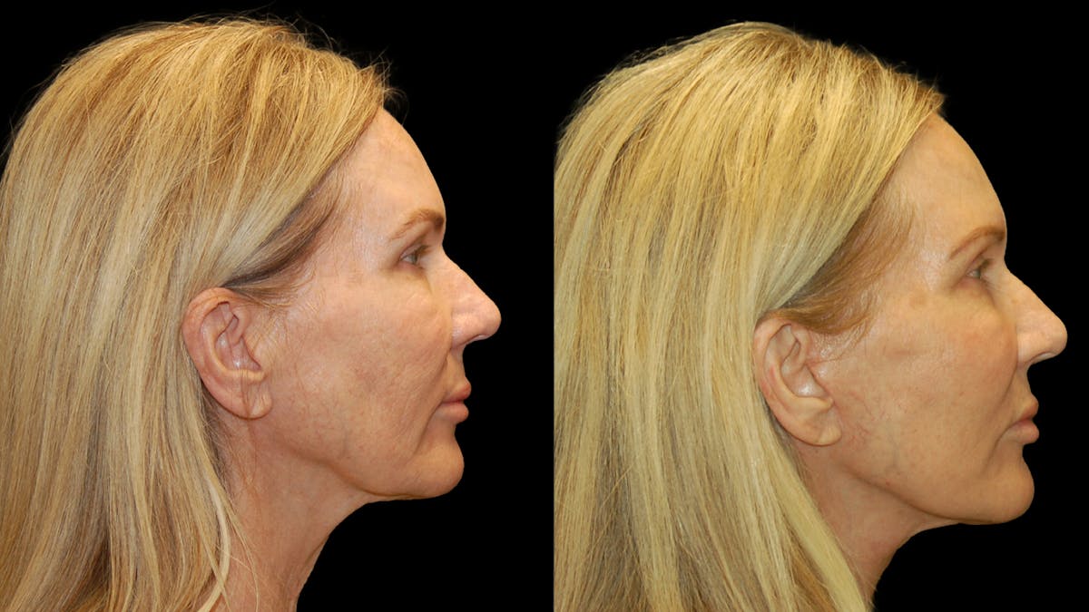 Lower Eyelid Surgery Before & After Gallery - Patient 132070 - Image 4