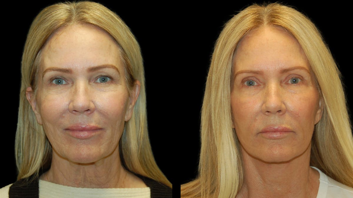 Lower Eyelid Surgery Before & After Gallery - Patient 132070 - Image 2