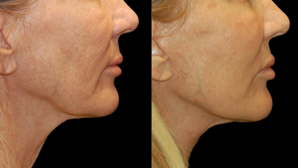 Lower Eyelid Surgery Before & After Gallery - Patient 132070 - Image 10