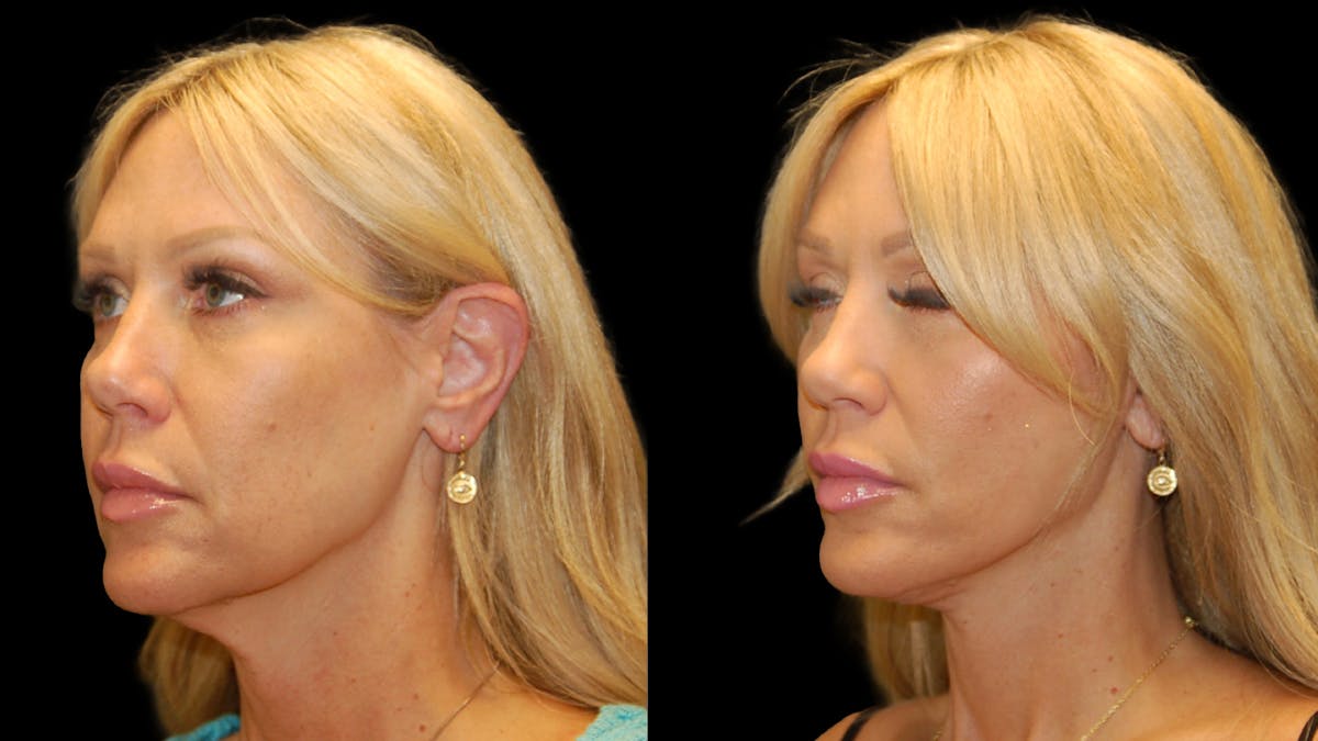 Lower Eyelid Surgery Before & After Gallery - Patient 769435 - Image 1