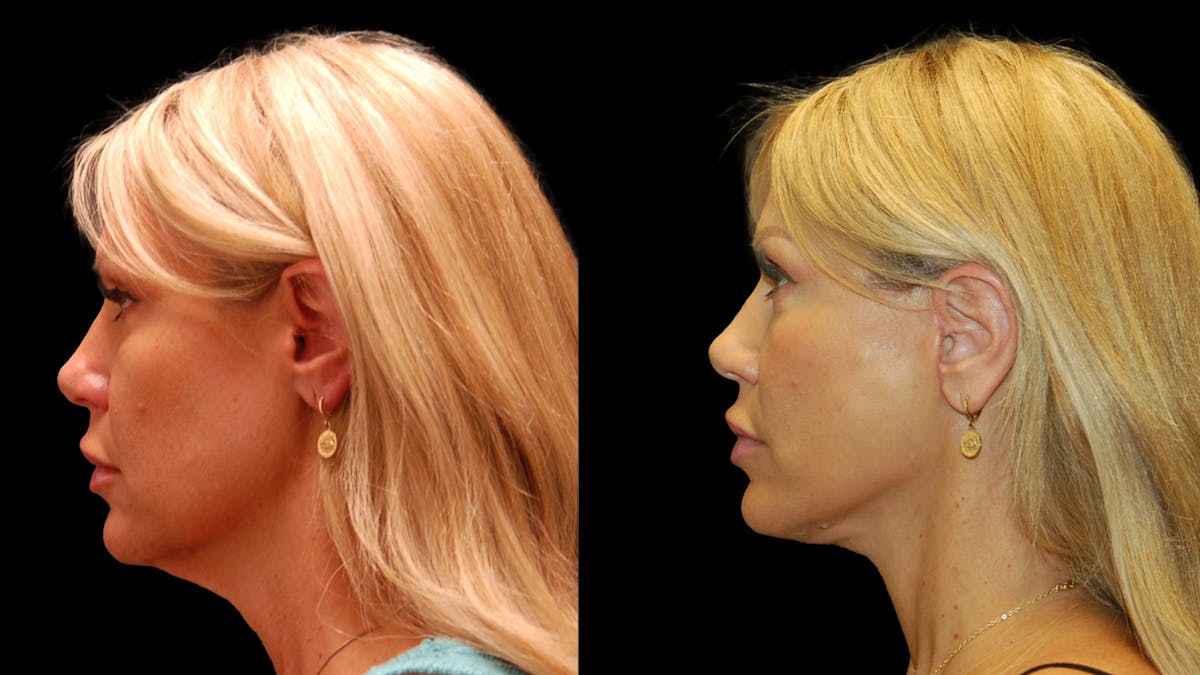 Lower Eyelid Surgery Before & After Gallery - Patient 769435 - Image 3