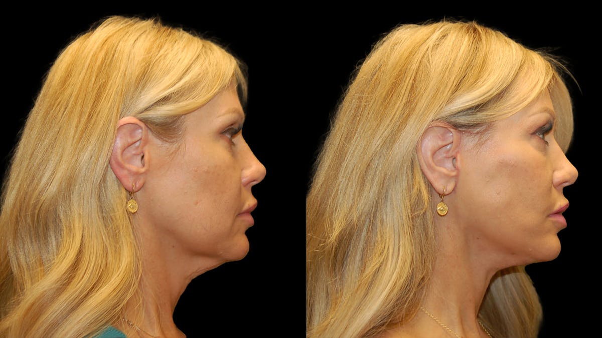 Lower Eyelid Surgery Before & After Gallery - Patient 769435 - Image 5
