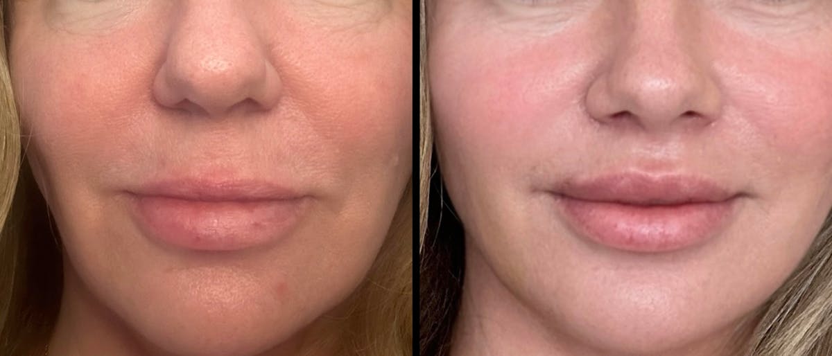 Lower Eyelid Surgery Before & After Gallery - Patient 769435 - Image 6