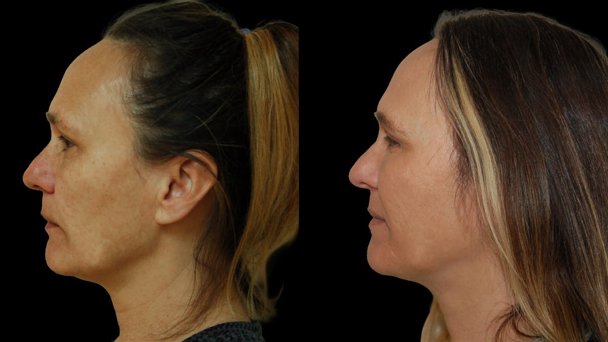 Lower Eyelid Surgery Before & After Gallery - Patient 328427 - Image 5