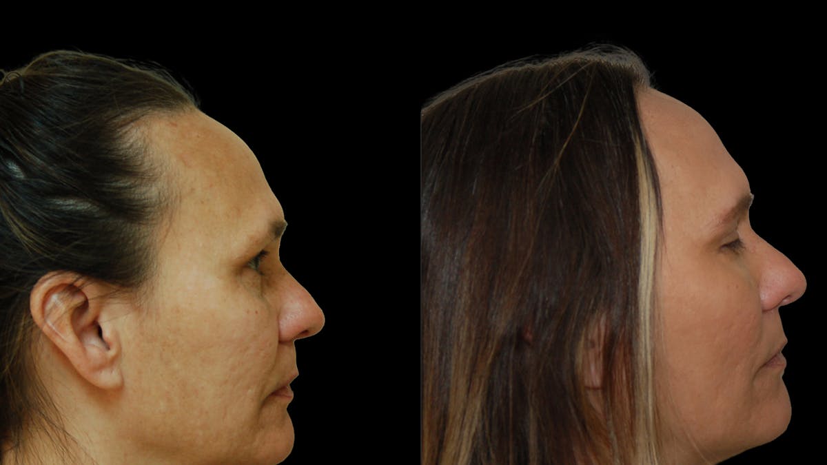 Lower Eyelid Surgery Before & After Gallery - Patient 328427 - Image 4