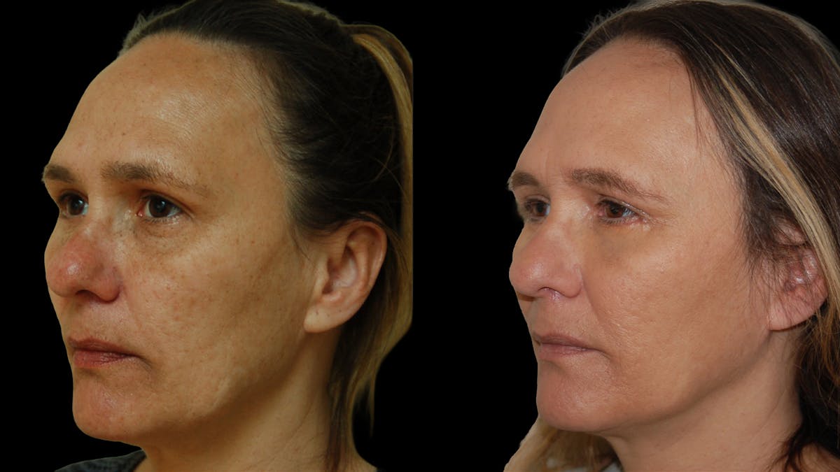 Lower Eyelid Surgery Before & After Gallery - Patient 328427 - Image 1
