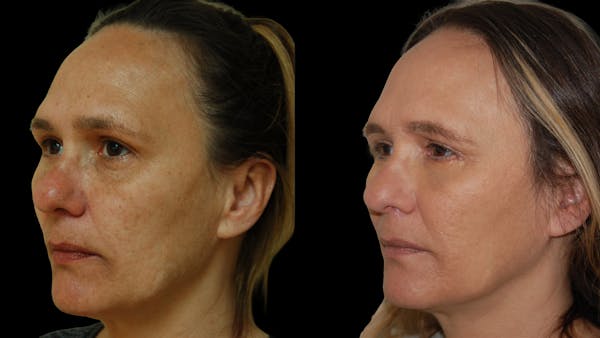 Lower Eyelid Surgery Before & After Gallery - Patient 328427 - Image 1