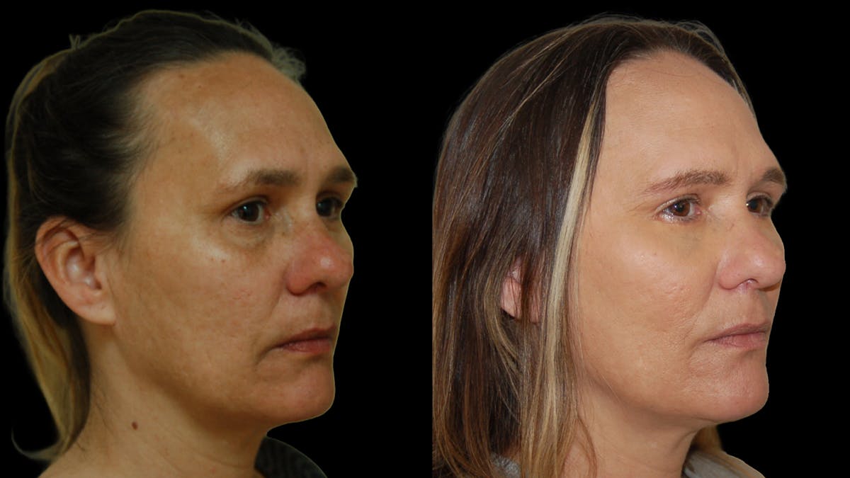 Lower Eyelid Surgery Before & After Gallery - Patient 328427 - Image 3