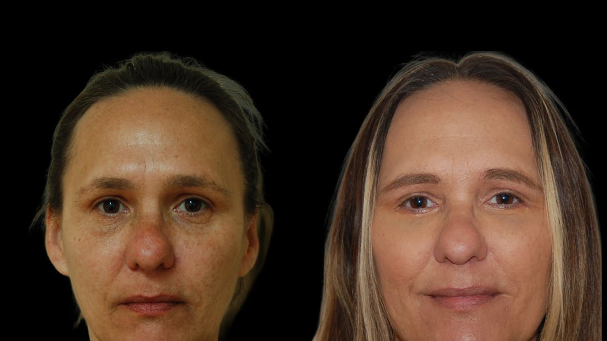Lower Eyelid Surgery Before & After Gallery - Patient 328427 - Image 2