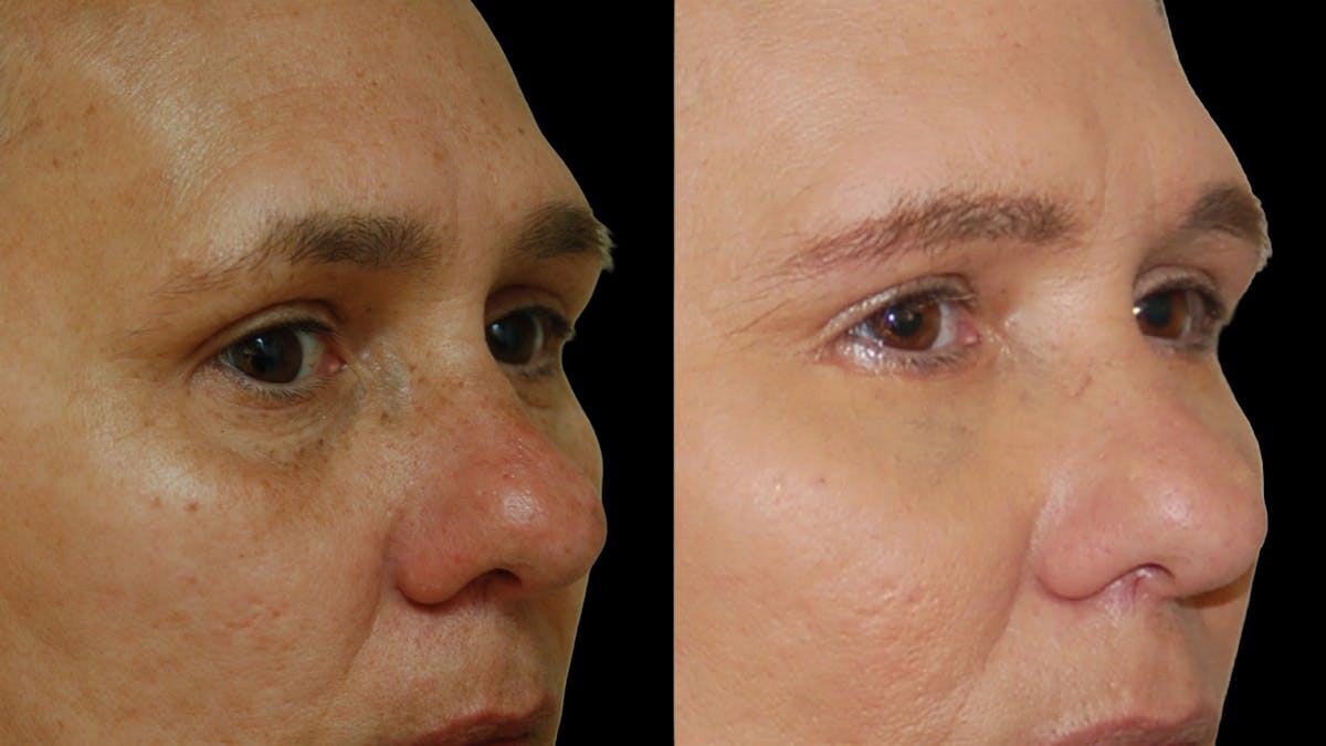 Lower Eyelid Surgery Before & After Gallery - Patient 328427 - Image 6