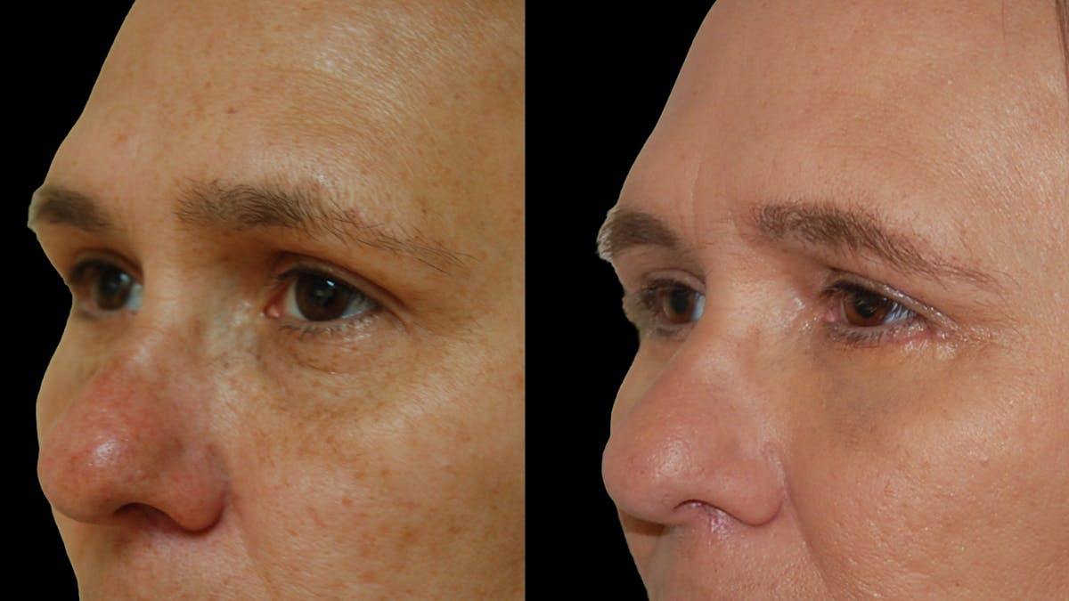 Lower Eyelid Surgery Before & After Gallery - Patient 328427 - Image 7
