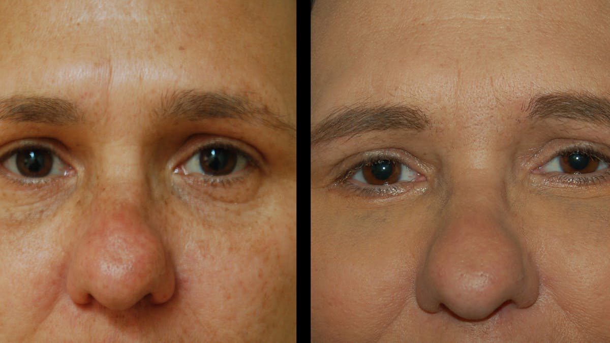 Lower Eyelid Surgery Before & After Gallery - Patient 328427 - Image 8
